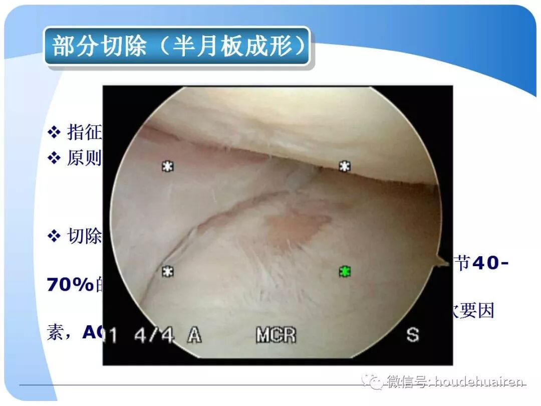 膝关节半月板损伤的诊断与治疗