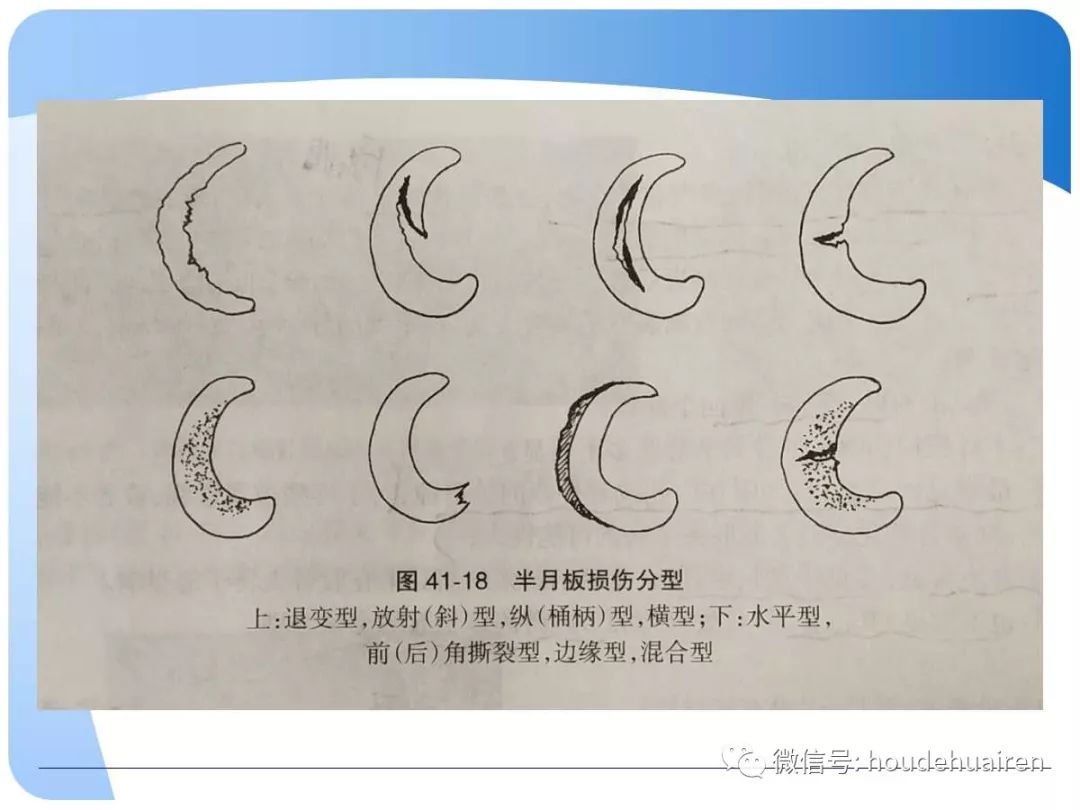 膝关节半月板损伤的诊断与治疗