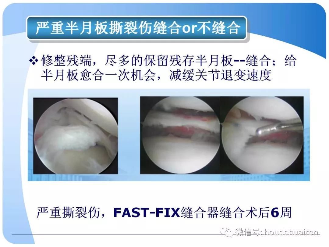 膝关节半月板损伤的诊断与治疗
