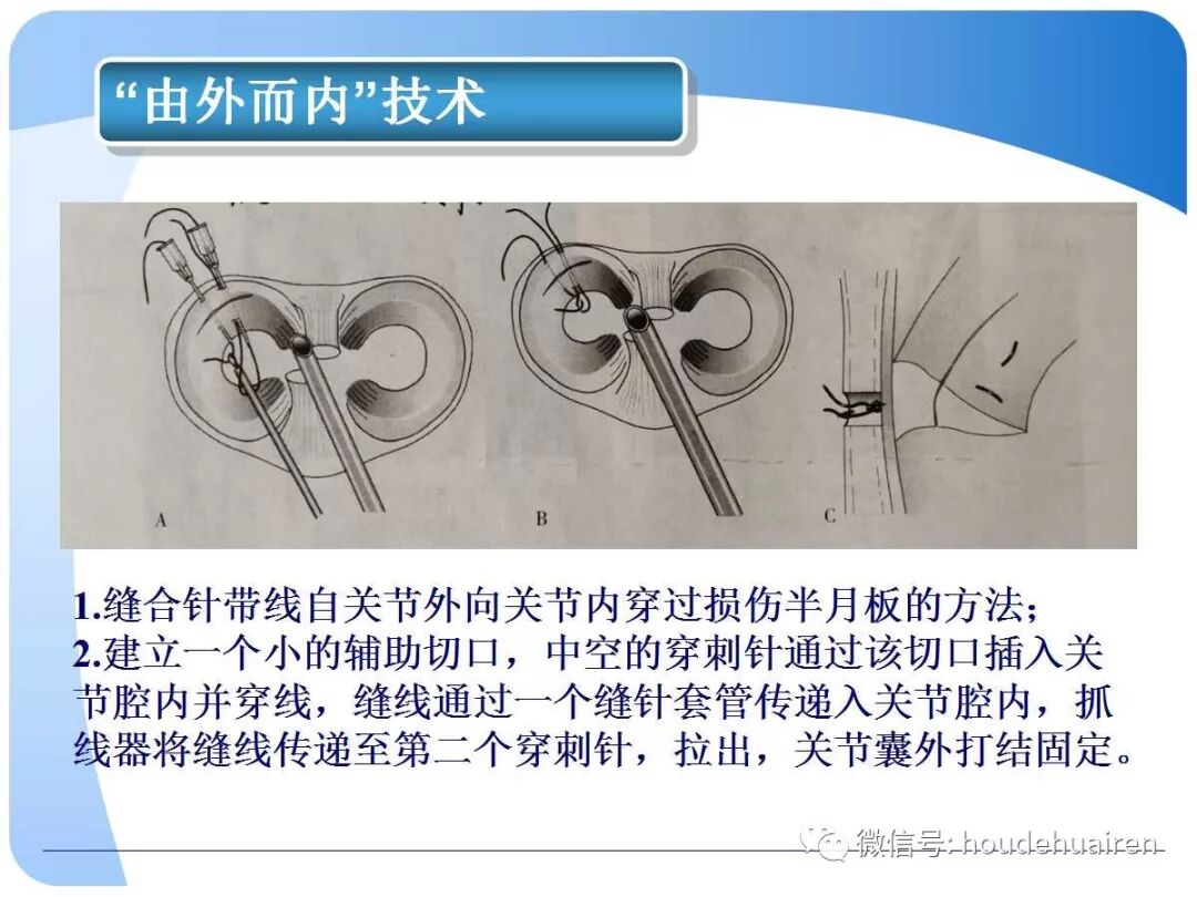 膝关节半月板损伤的诊断与治疗