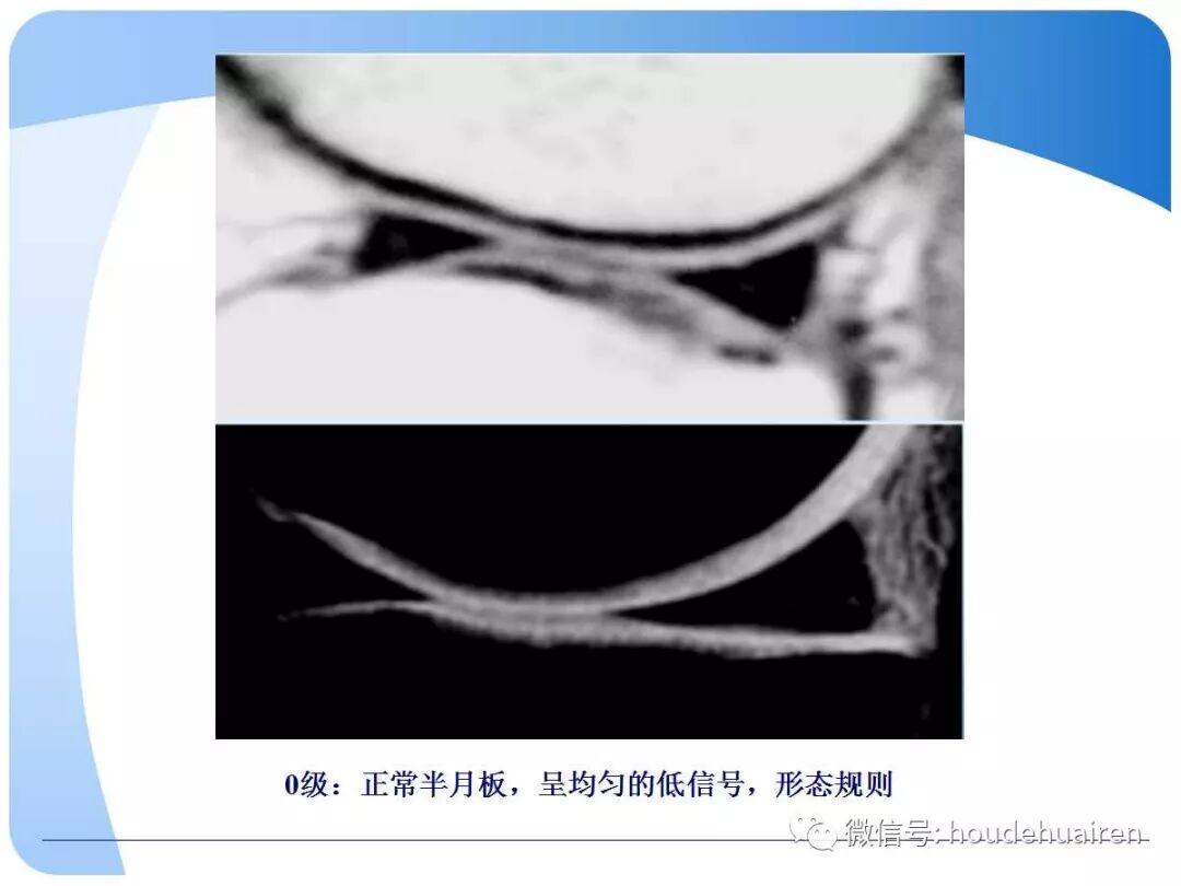 膝关节半月板损伤的诊断与治疗
