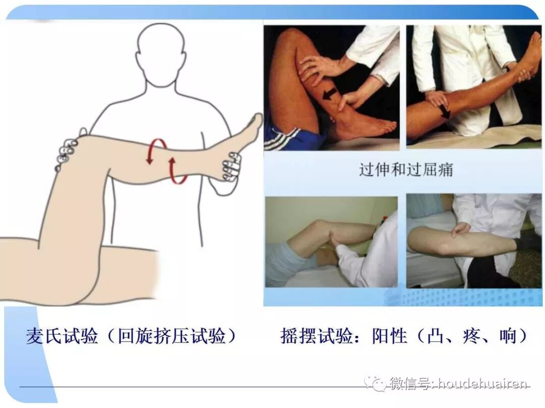 膝关节半月板损伤的诊断与治疗