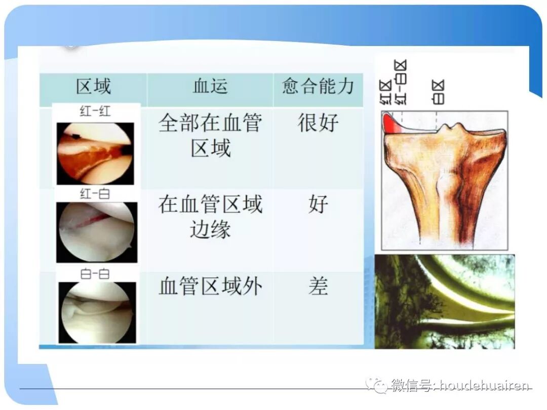 膝关节半月板损伤的诊断与治疗