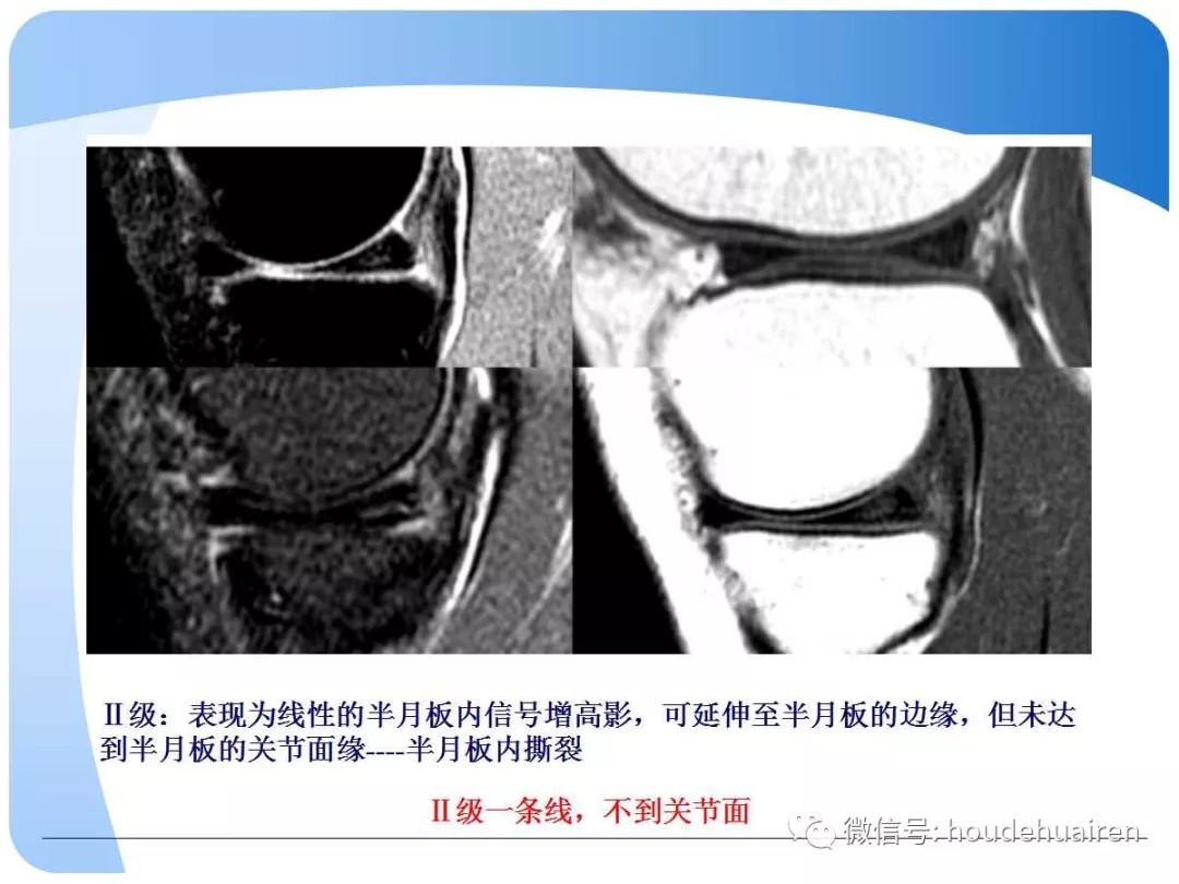 膝关节半月板损伤的诊断与治疗
