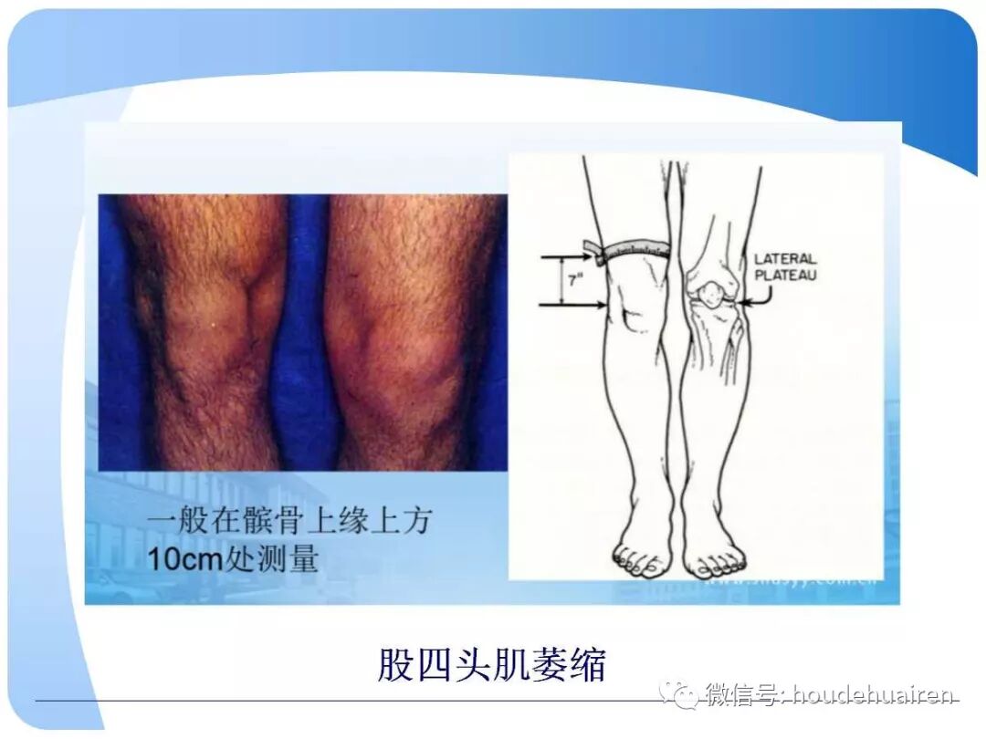 膝关节半月板损伤的诊断与治疗