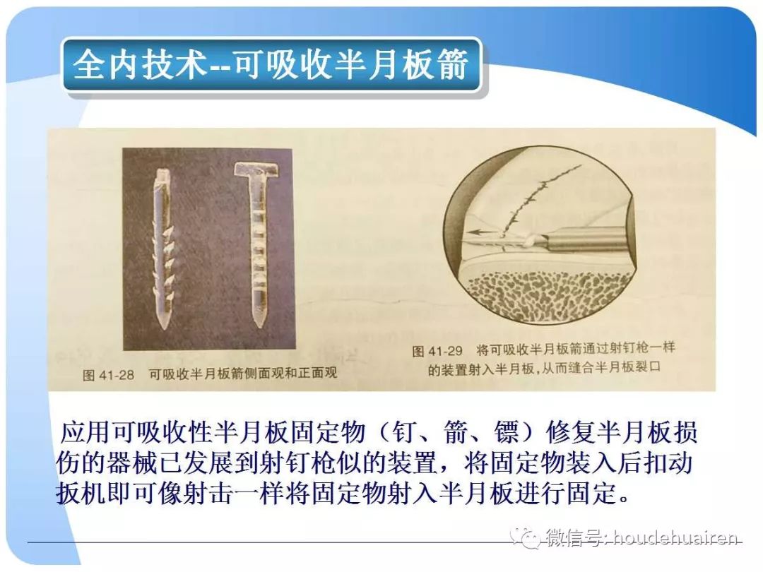 膝关节半月板损伤的诊断与治疗