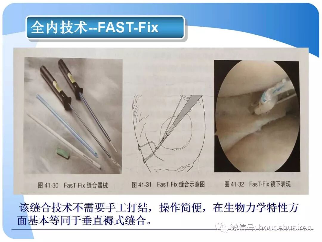 膝关节半月板损伤的诊断与治疗