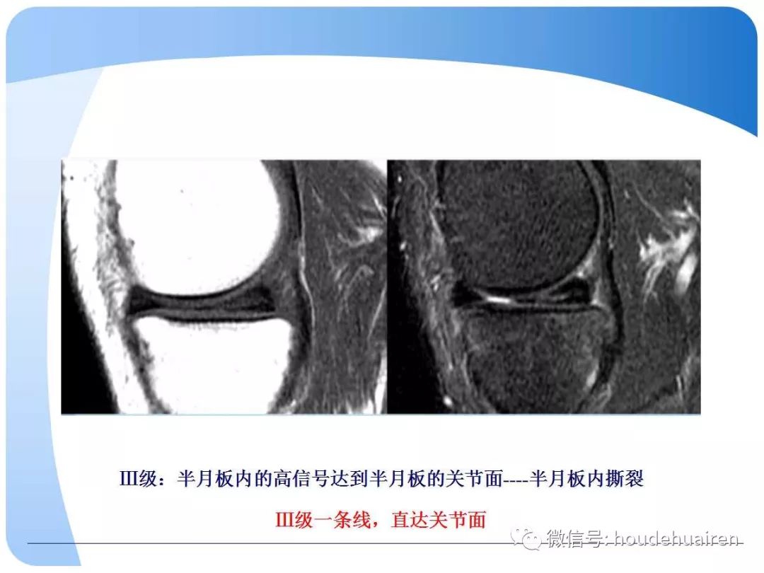 膝关节半月板损伤的诊断与治疗