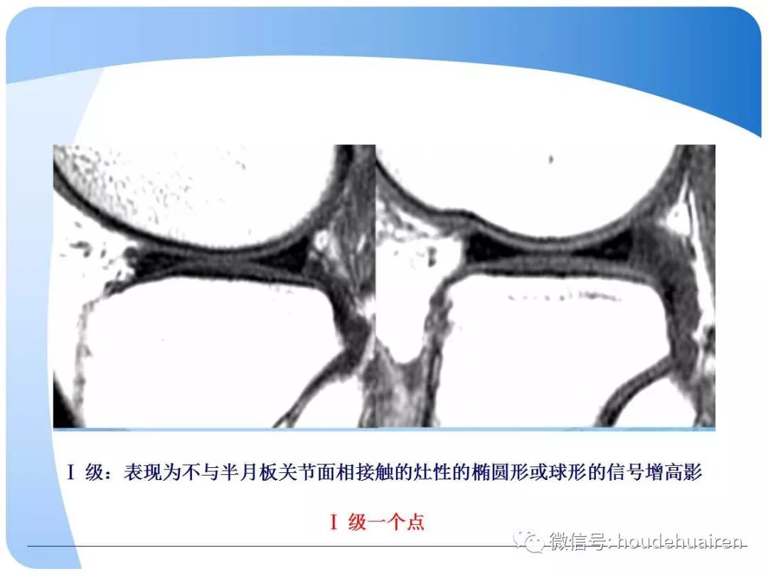 膝关节半月板损伤的诊断与治疗