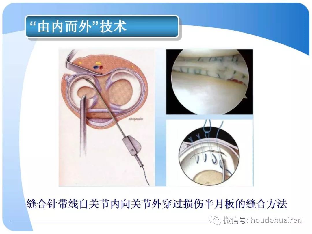 膝关节半月板损伤的诊断与治疗