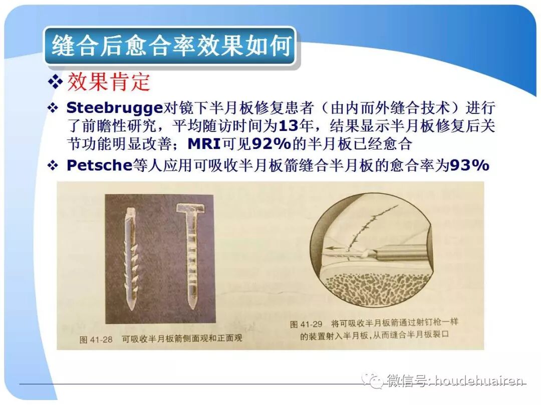 膝关节半月板损伤的诊断与治疗