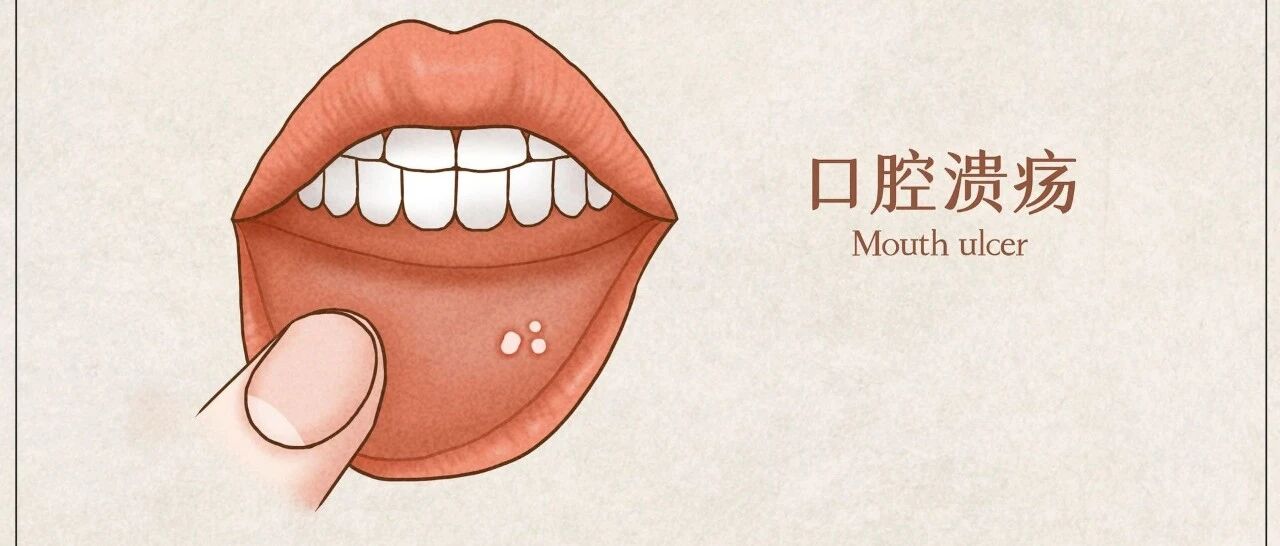 口腔溃疡真烦人，我方请求紧急支援！