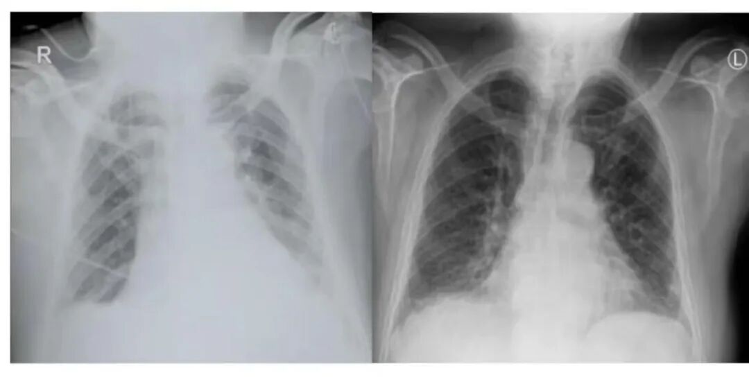 床旁DR机怎么移动影像科普 ｜ 非必要，不要轻易拍摄床旁胸片_https://www.jmylbn.com_新闻资讯_第4张