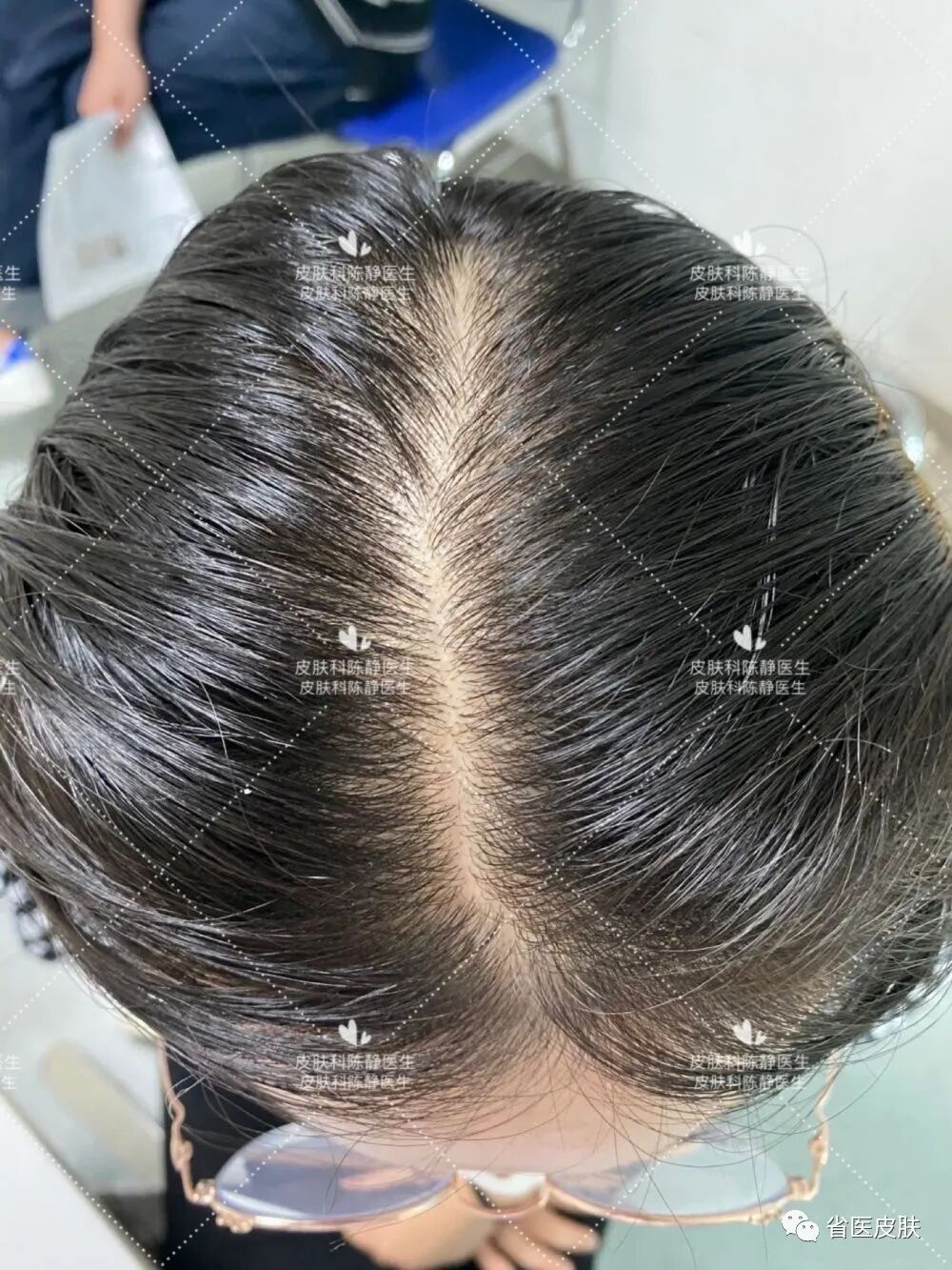 渐渐消失的头发——女性雄激素性脱发|优势技术 - 皮肤科 - 科室导航
