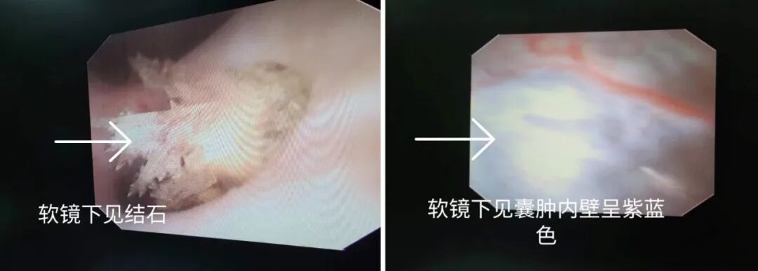 输尿管软镜有什么品牌与石俱净，不用开刀！二附院开展柔性可弯输尿管导引鞘＋电子软镜技术治疗肾结石_https://www.jmylbn.com_新闻资讯_第2张