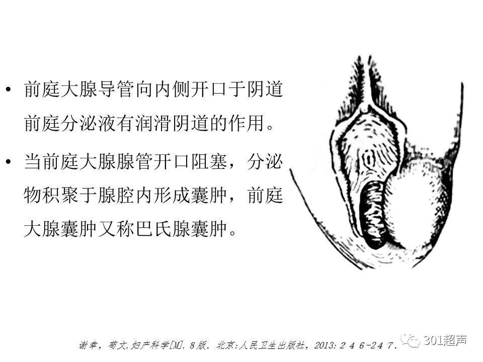 前庭大腺囊肿 301超声 微信公众号文章阅读 Wemp