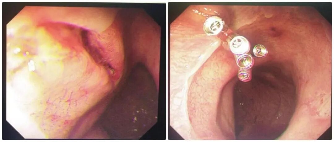 内镜夹怎么不掉贲门撕裂大出血危在旦夕，内镜下“夹”然而止化险为夷_https://www.jmylbn.com_新闻资讯_第7张
