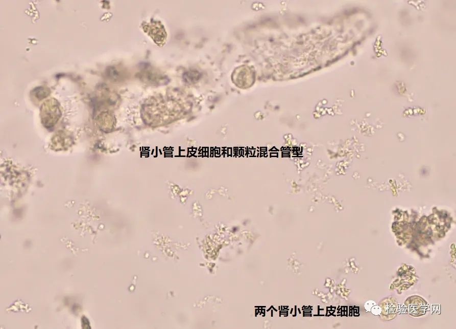 警惕这类病例!尿蛋白不高甚至阴性,却检出管型-微信头条网 警惕这类病例!尿蛋白不高甚至阴性,却检出管型