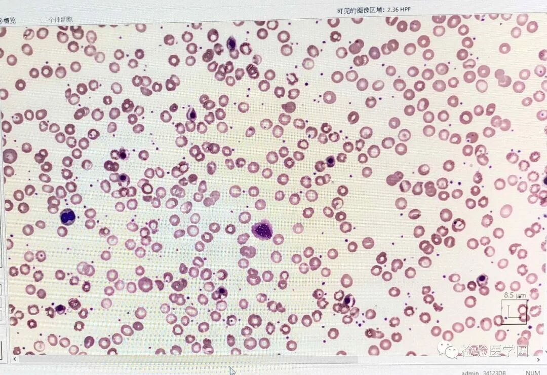 血常规用什么仪器检查同厂家仪器两次血常规结果相差巨大，原因值得所有检验人警惕！_https://www.jmylbn.com_新闻资讯_第4张