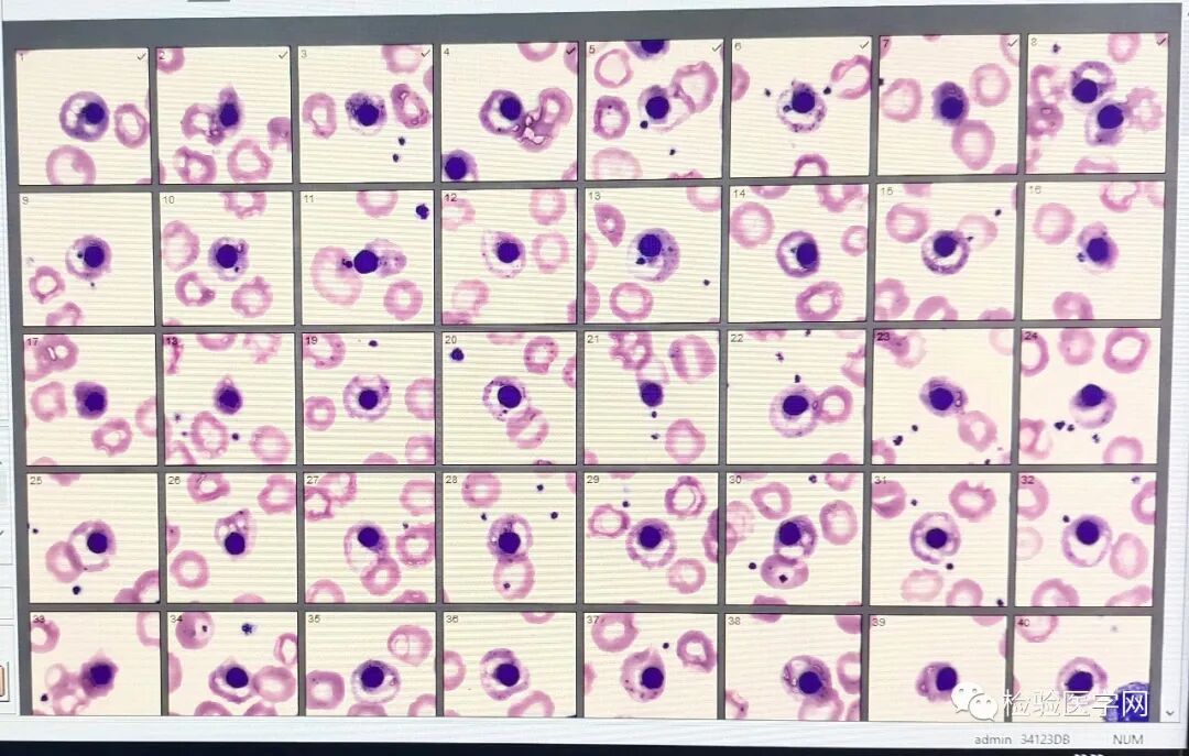 血常规用什么仪器检查同厂家仪器两次血常规结果相差巨大，原因值得所有检验人警惕！_https://www.jmylbn.com_新闻资讯_第5张