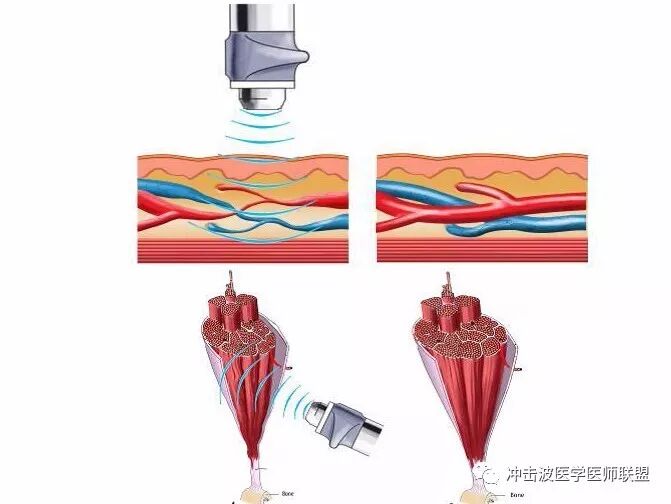 体外冲击波疗法治疗髋关节滑膜炎疾病
