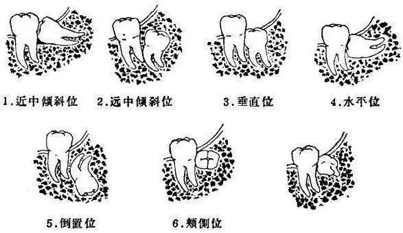 另一個後果是前傾的智齒持續加力於第二磨牙使其形成牙周炎而疼痛鬆動