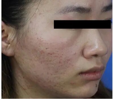 什么是医用透明质酸钠【医学美容】关于透明质酸钠复合溶液（嗨体），你知道吗？_https://www.jmylbn.com_新闻资讯_第19张