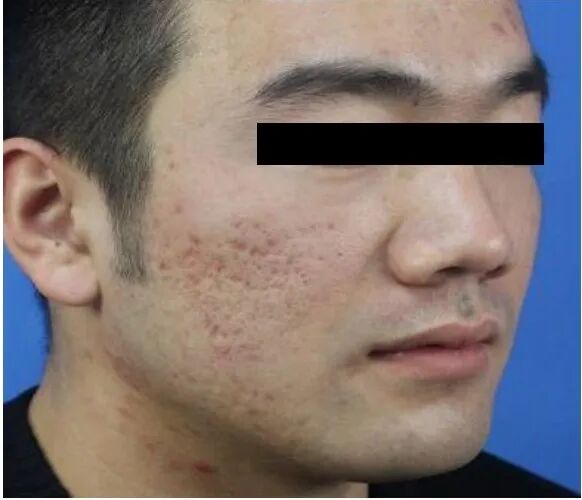 什么是医用透明质酸钠【医学美容】关于透明质酸钠复合溶液（嗨体），你知道吗？_https://www.jmylbn.com_新闻资讯_第21张