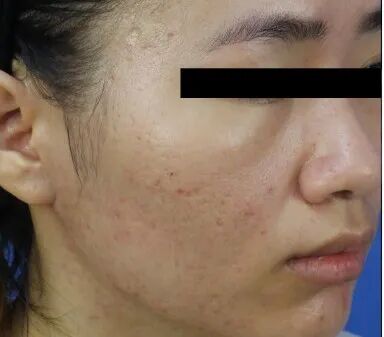 什么是医用透明质酸钠【医学美容】关于透明质酸钠复合溶液（嗨体），你知道吗？_https://www.jmylbn.com_新闻资讯_第20张