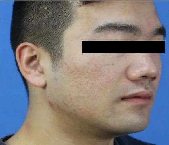 什么是医用透明质酸钠【医学美容】关于透明质酸钠复合溶液（嗨体），你知道吗？_https://www.jmylbn.com_新闻资讯_第22张