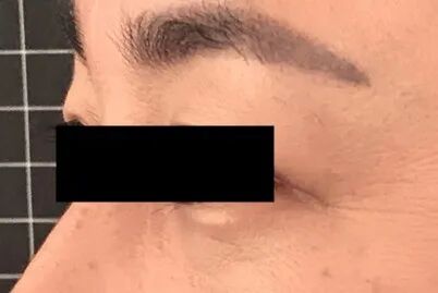 什么是医用透明质酸钠【医学美容】关于透明质酸钠复合溶液（嗨体），你知道吗？_https://www.jmylbn.com_新闻资讯_第15张