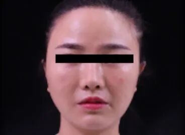 什么是医用透明质酸钠【医学美容】关于透明质酸钠复合溶液（嗨体），你知道吗？_https://www.jmylbn.com_新闻资讯_第24张