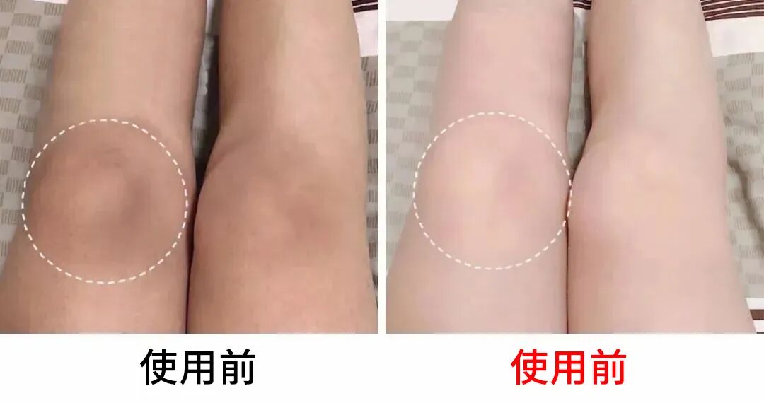 理疗热敷贴怎么贴这个东西是老寒腿克星！每天坚持能让腿脚年轻20岁！_https://www.jmylbn.com_新闻资讯_第19张