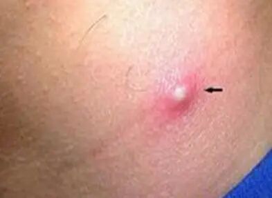 毛囊炎不同部位不同症状，3个简单方法解决毛囊炎