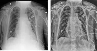 悬吊DR怎么安装学科建设 ‖ 放射科“再添利器”---我院引进DRX-Compass X悬吊结构DR系统_https://www.jmylbn.com_新闻资讯_第4张