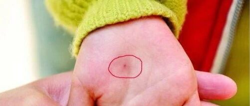 愤怒！孩子不听话，就用针扎！这家幼儿园老师，居然干出这种事！