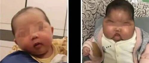 揪心！5月龄宝宝成大头娃娃，激素宝宝霜要警惕！