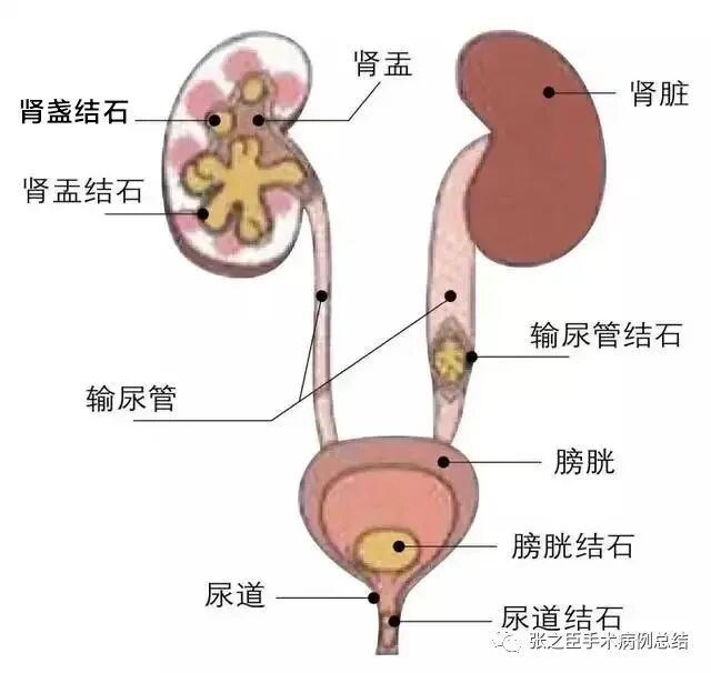 泌尿导丝怎么收费泌尿系结石治疗系列2——经尿道输尿管硬镜碎石取石术_https://www.jmylbn.com_新闻资讯_第1张