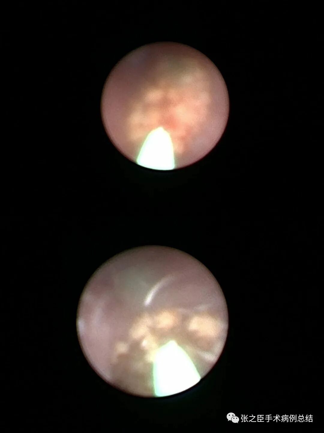 泌尿导丝怎么收费泌尿系结石治疗系列2——经尿道输尿管硬镜碎石取石术_https://www.jmylbn.com_新闻资讯_第4张