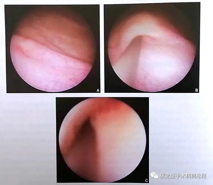 泌尿导丝怎么收费泌尿系结石治疗系列2——经尿道输尿管硬镜碎石取石术_https://www.jmylbn.com_新闻资讯_第3张