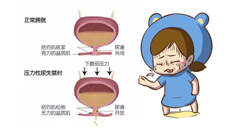 女性漏尿偏方大全图片