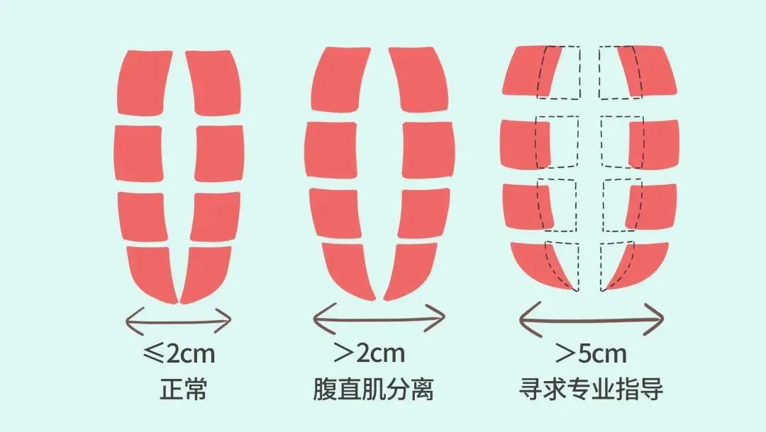 腹直肌分离2指图片