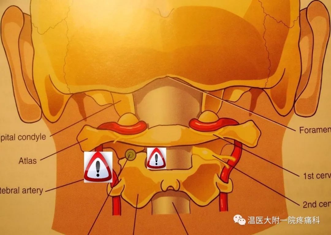 頸2背根神經節射頻治療頸源性頭痛