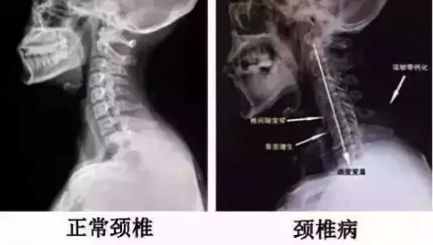 頭暈、眼花,半夜睡覺脖子還老不舒服?這是病,得治! 頭暈、眼花,半夜睡覺脖子還老不舒服?這是病,得治!