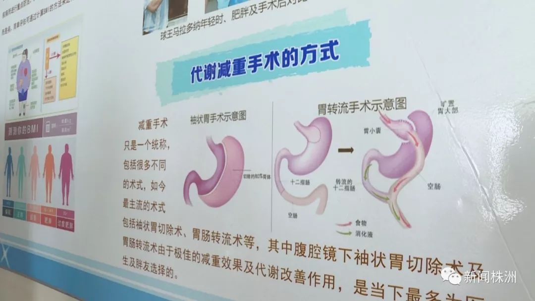 手术减肥_减肥手术哪种效果好_减肥手术后遗症