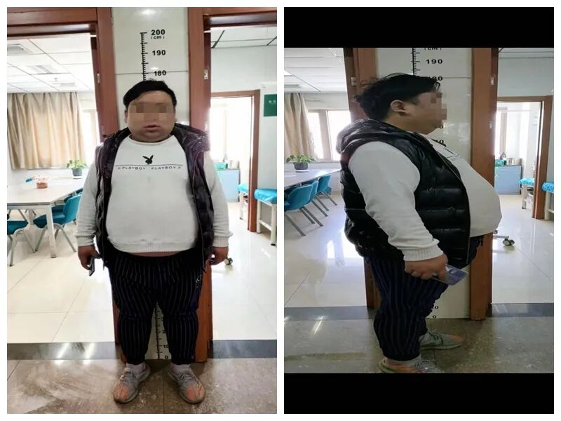 减肥手术后遗症_减肥手术多少钱_手术减肥