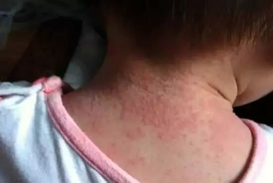 螨虫症状表现图片_螨病图片_被螨虫咬的症状图片