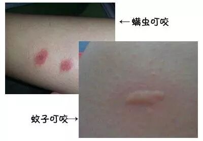 被螨虫咬的症状图片_螨病图片_螨虫症状表现图片