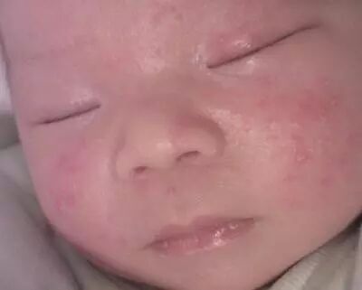 螨病图片_螨虫症状表现图片_被螨虫咬的症状图片