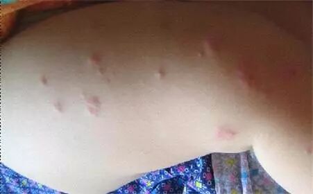 被螨虫咬的症状图片_螨虫症状表现图片_螨病图片